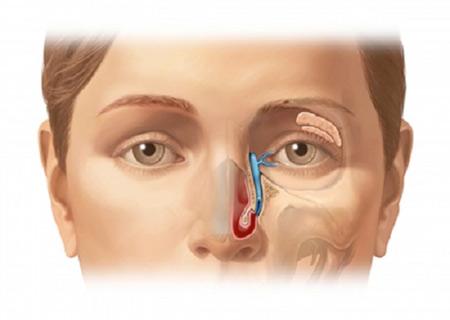 nhiễm trùng ổ mắt - hậu quả của viêm xoang
