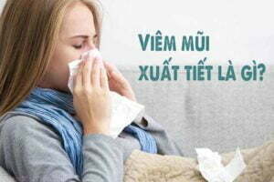 bệnh viêm mũi xuất tiết