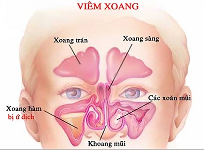 IV. Phương pháp chẩn đoán viêm xoang sàng 2 bên