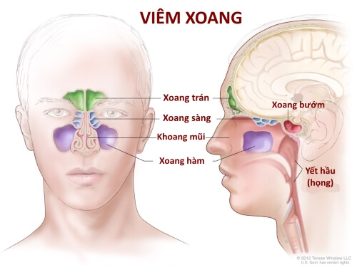 Viêm xoang - Chứng bệnh phổ biến của Việt Nam 