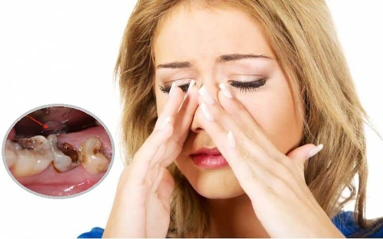 Biểu hiện điển hình của viêm xoang gây đau răng