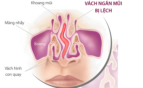vẹo lệch vách ngăn mũi khả năng mắc viêm xoang trán cao