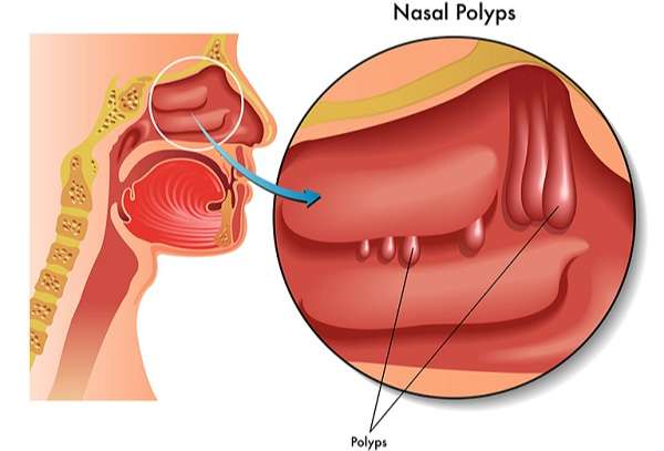 Phẫu thuật cắt polyp mũi 