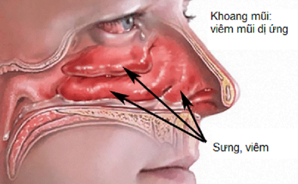 Tìm hiểu bệnh viêm mũi dị ứng 