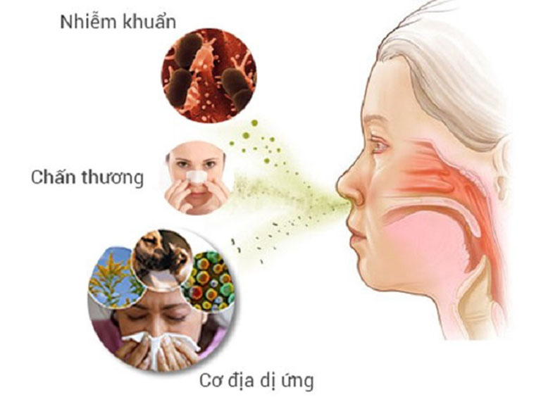 Nguyên nhân gây viêm mũi dị ứng bội nhiễm
